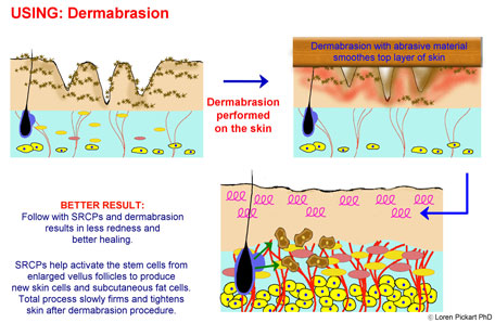 What to Use After Dermabrasion